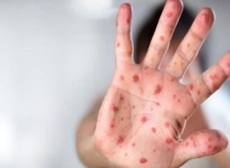 “بوحمرون” يعود للظهور في المغرب.. وزارة الصحة تحذر وتشدد على أهمية التلقيح