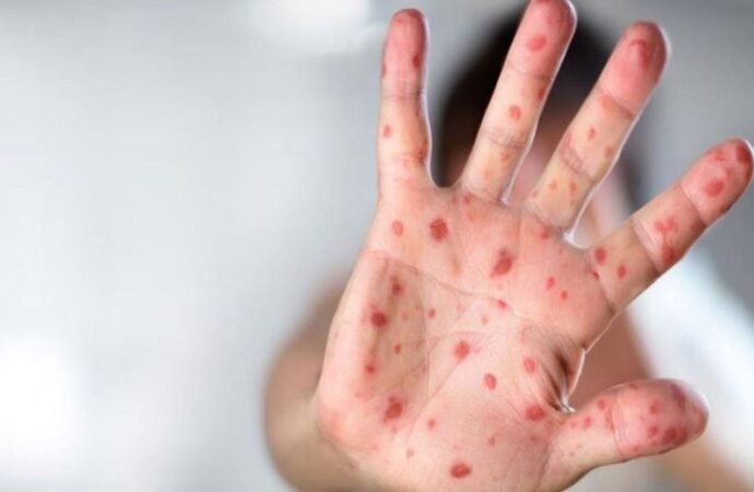 “بوحمرون” يعود للظهور في المغرب.. وزارة الصحة تحذر وتشدد على أهمية التلقيح